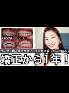 [x]マウスピース一年やったらこうなりました【ワイヤーと比較していく途中経過報告